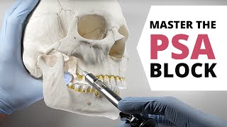 HOW TO DO A POSTERIOR SUPERIOR ALVEOLAR PSA NERVE BLOCK  OnlineExodontiacom [upl. by Nira337]