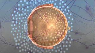 Vitrectomy Surgery for Diabetic Retinopathy [upl. by Inahpets]