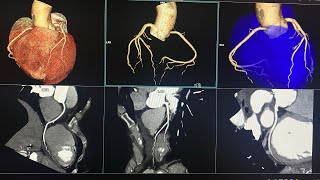 CTA CORONARY  Siemens 128 Somatom goTop  65 ml Contrast flow rate 55 mls HMS MIRDIF HOSPITAL [upl. by Fenelia]