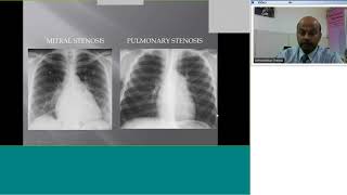 Pedicardio classes on Pulmonary stenosis Dx and Rx incl Balloon valvuloplasty by Dr Premsekar [upl. by Drof]