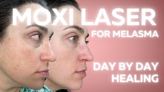 MOXI LASER FOR MELASMA DAY BY DAY HEALING [upl. by Llemrej955]