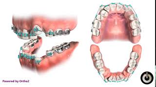 4 First Premolar Extraction for Crowding  Dental Braces  Temecula Valley CA [upl. by Crescin]