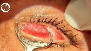 Chalazion surgery [upl. by Law656]