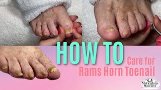 How to Pedicure Nail Care on Rams Horn Toenail [upl. by Romano]