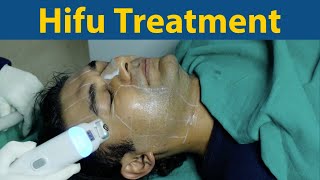 Hifu Face Lifting Treatment  Breaking the myths with Dr Jyoti Gupta  NONSurgical Face Lift [upl. by Esinrahs444]