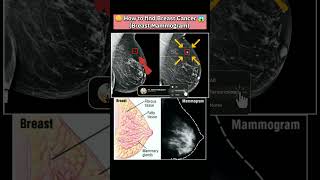 🤔How to find Breast Cancer😱 cancer breastcancer xray youtubeshorts mammogram disease medical [upl. by Lucienne]