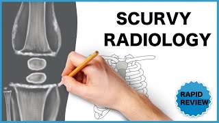 Scurvy Radiological Findings [upl. by Asseret]