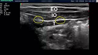 ILIOINGUINAL AND ILIOHYPOGASTRIC BLOCKS [upl. by Lasley141]