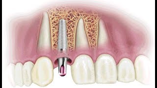 Como é a instalação de implante dentário e sua osseointegração [upl. by Suired314]