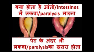 what is INTESTINAL PSEUDO  OBSTRUCTIONPARALYTIC ILEUSOGILVIE SYNDROME [upl. by Natsyrt]