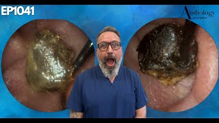 The Most Shocking Ear Wax Removal Youve Never Seen  EP1041 [upl. by Asim]