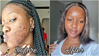 How I finally cleared my acne prone skin  Skin care routine🧴with photo evidence [upl. by Onidranreb964]