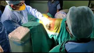 Intrathecal MorphineBaclofen Pump Implantation [upl. by Enidan]