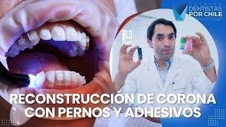 Elección de Pernos y Adhesivos  Clínica Dentistas por Chile [upl. by Erasmo260]