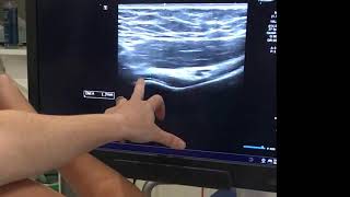 IGHL adhesive capsulitis ultrasound [upl. by Giana692]