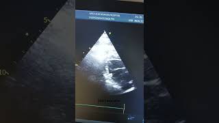 2D Echo Cardiography parasternal short axis view [upl. by Cirle]