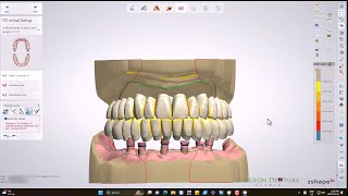 CUDCLD with Implants [upl. by Lekzehcey]