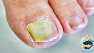 DAMAGED BIG TOENAIL COMPLETELY LIFTED HOW TO TREAT LIFTED TOENAILS [upl. by Sawyor634]