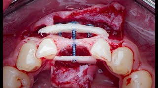 khoury technique for rebuilding severe horizontal bone defect [upl. by Sherburn]