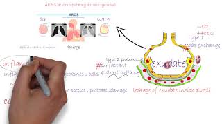 ARDS acute respiratory distress syndromeشرح [upl. by Suiradal803]