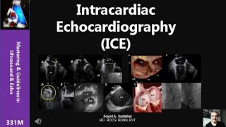 Intracardiac Echocardiography ICE [upl. by Musette55]