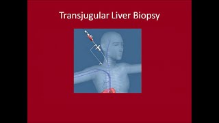 Transjugular Liver Biopsy [upl. by Adiv]