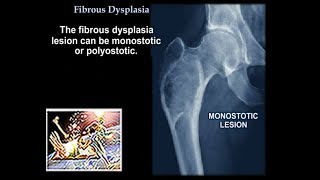 Fibrous Dysplasia  Everything You Need To Know  Dr Nabil Ebraheim [upl. by Ylrebnik]