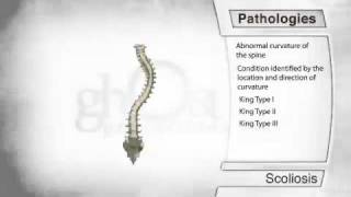 Scoliosis Pathology [upl. by Weissberg]