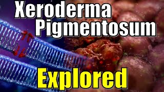 quot Vampire Syndrome quot Xeroderma Pigmentosum DNA Damaged Explained  Effects of UV Radiation on Genes [upl. by Mokas809]