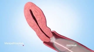 Sperm Retrieval Techniques [upl. by Mount]