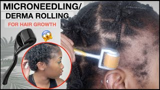 MICRONEEDLINGDERMA ROLLING FOR EDGE GROWTH  Two Month Update  TRACTION ALOPECIA 🚨 NO MINOXIDIL [upl. by Roshelle]