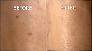 This is Fifty SUCCESS Removing Brown Spots on Hand wDermavel Plasma Pen [upl. by Marzi]