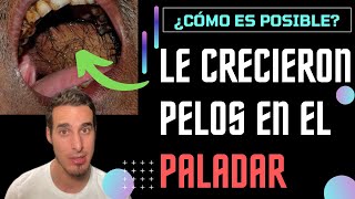 Le crecen PELOS en el paladar boca y lengua  ¿Cómo es posible [upl. by Nahshunn]