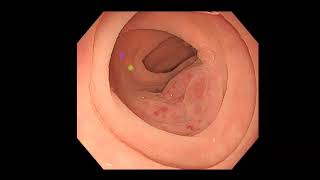 Arteriovenous malformations of the colon evaluated using hemodynamic parameters in color Doppler EUS [upl. by Cartan723]