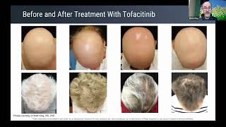 Alopecia areata treatment update and lessons learned from recent clinical trials [upl. by Cassady]