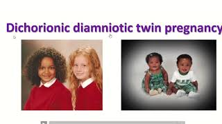 Anatomy of dichorionic and diamniotic twin pregnancy with sonographic feature twin obimagesnet [upl. by Kcim336]