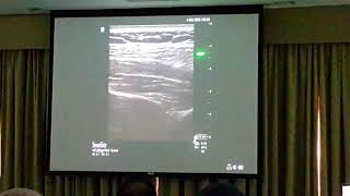 NYSORA Dubai 2019 USG Suprascapular Nerve Block [upl. by Meekah]