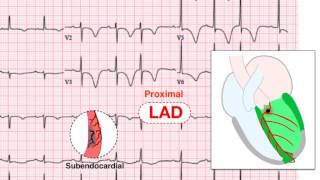 Ischemia 57 Examples of UA and NSTEMI [upl. by Natsreik]