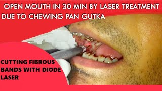 Laser Cutting of Fibrous Band of OSMF Patient ORAL SUBMUCOUS FIBROSIS TREATMENT [upl. by Atiras]