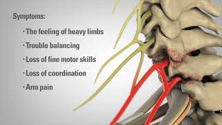 Cervical Laminectomy  Patient Animation [upl. by Cacia]