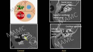 TMT Inner Ear by Dr Jyoti Kumar  Part II [upl. by Prudi]