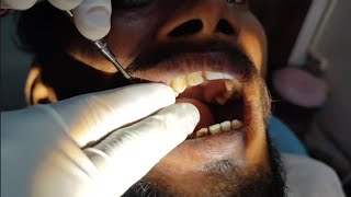 Extraction In Restricted Mouth Opening Patient  Extraction Trick  Upper 1st Molar Extraction 🦷 [upl. by Einned]