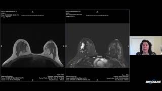 Breast MRI BIRADS Assessment [upl. by Virgin]