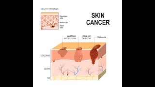 quotEarly Signs of Skin Cancer What You Need to Watch Forquot [upl. by Rehpotsrik321]