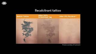 PicoSure Laser Tattoo Removal [upl. by Nlycaj239]