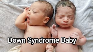 Down Syndrome Twins Newborn babies after birth beautiful cute special [upl. by Frohman]