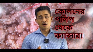 কোলনের পলিপ থেকে ক্যান্সার [upl. by Constantina954]