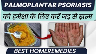 पामोप्लांटर सोरायसिस का घरेलू इलाज  Palmoplantar Psoriasis Symptoms and Treatment in Hindi [upl. by Teufert]