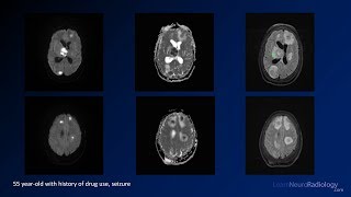 Intracranial infections  3  Focal Infections [upl. by Id]