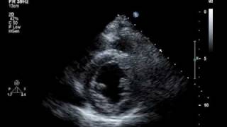 Hypokinesis Mitral Regurgitation Aortic Insufficiency [upl. by Ocirne]